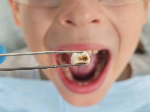 Best Knocked-Out Tooth Emergency  in Moose Lake, MN